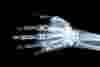 An X-ray image of a person’s left hand and wrist, without fractures.